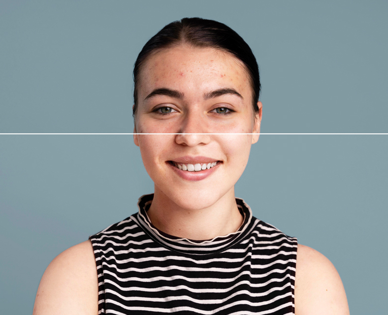 780×633-Acne-Scar-treatment