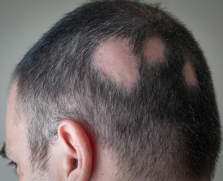 780×633-Alopecia-areata