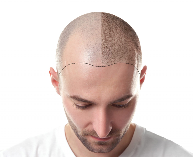 780×633-Micropigmentation