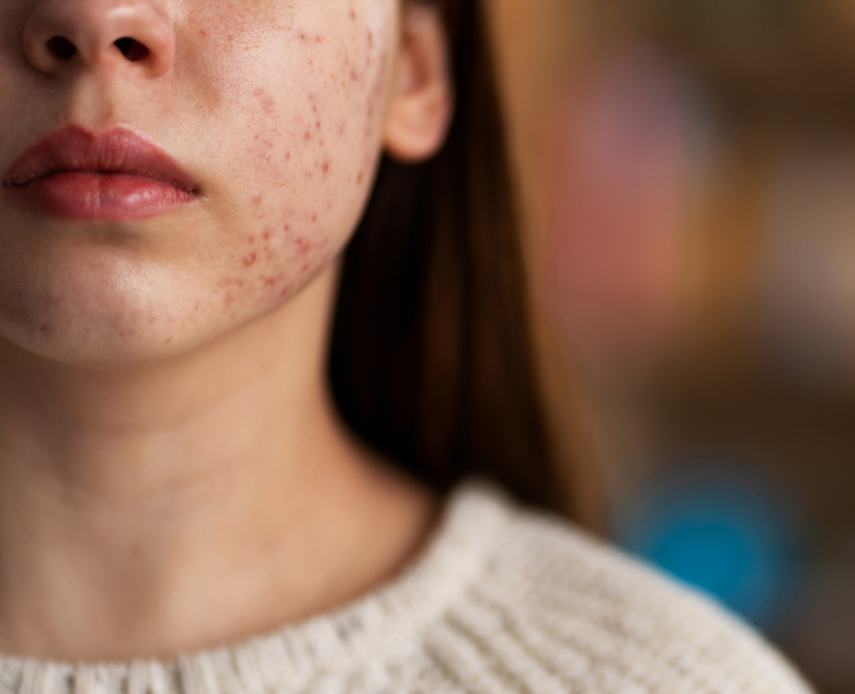 780×633-Bacterial-Infection