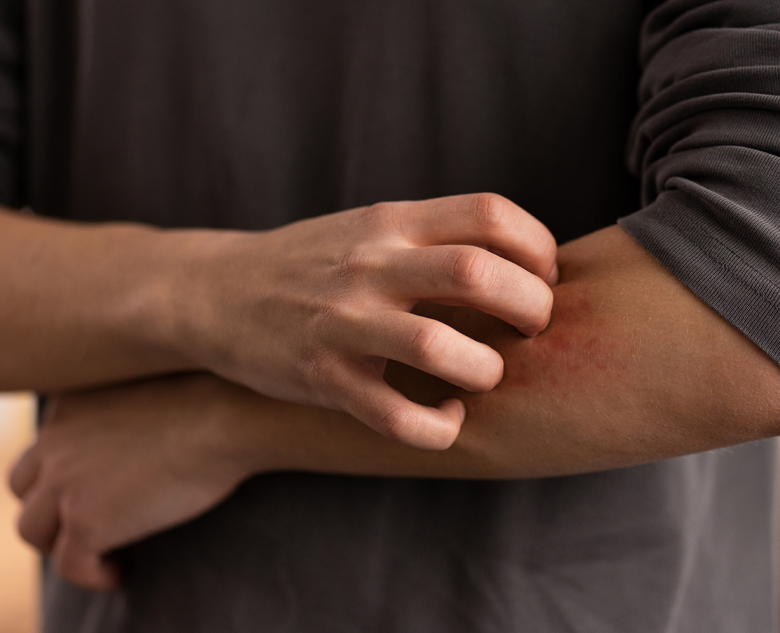 780×633-Fungal-Infection