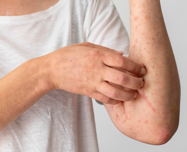 780×633-Itching-or-Allergy