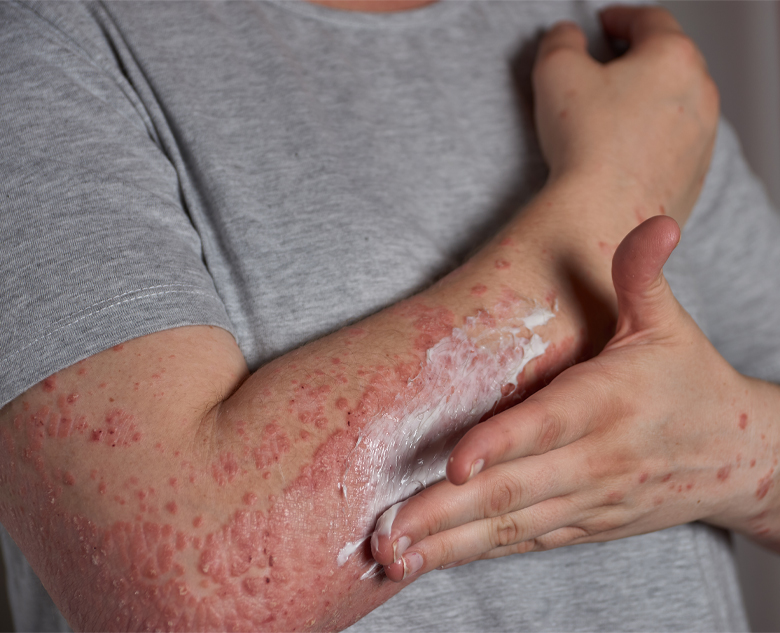 780×633-Psoriasis