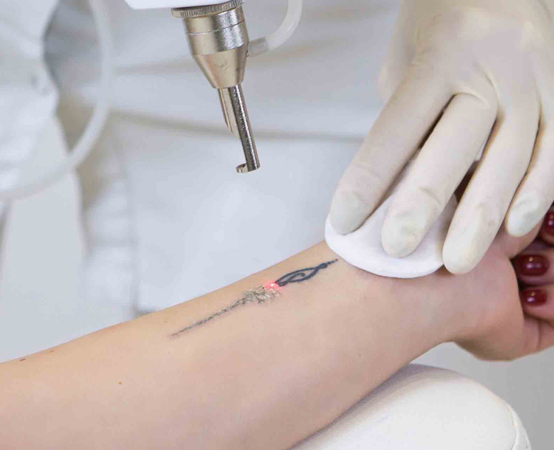 780×633-Tattoo-Removal